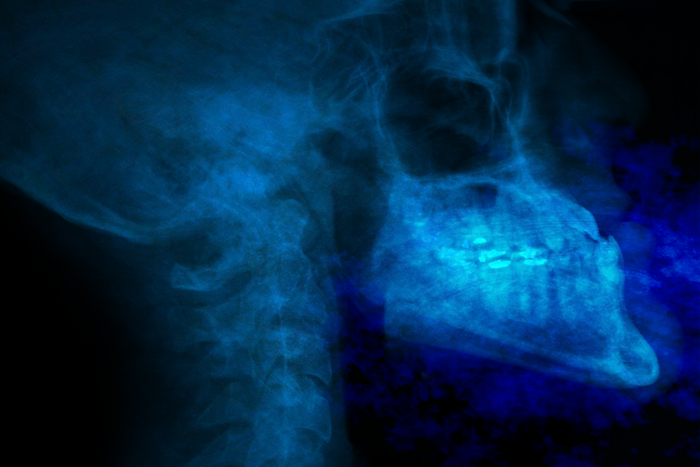 Blaue Röntgenaufnahme von Schädel