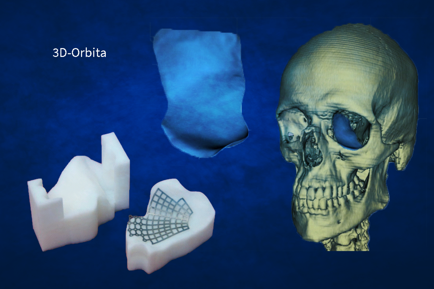 Schädelmodell mit Orbita-Implantaten